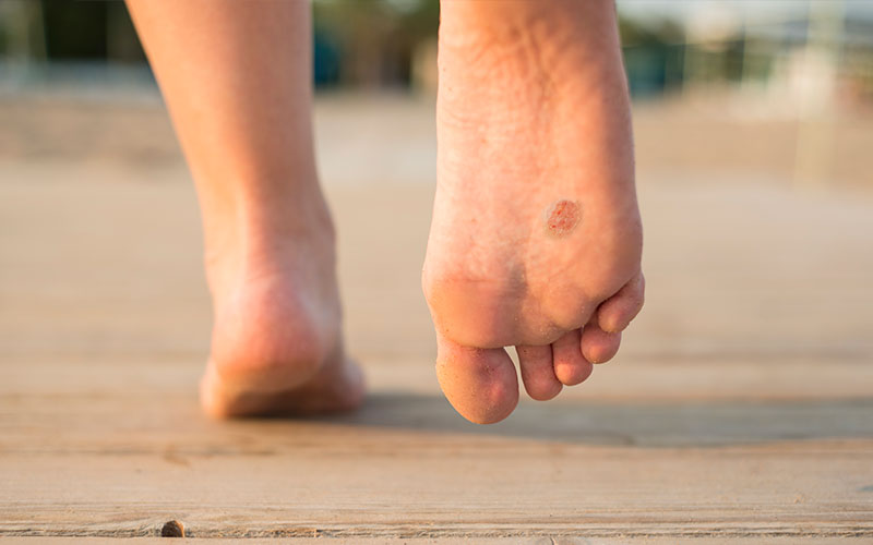 Malignant Melanoma Foot